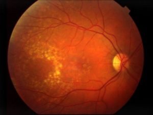 15723935_Macular-Degeneration