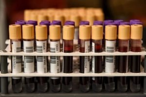 κορονοιοσ lab test