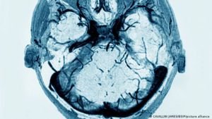 brain egefalos