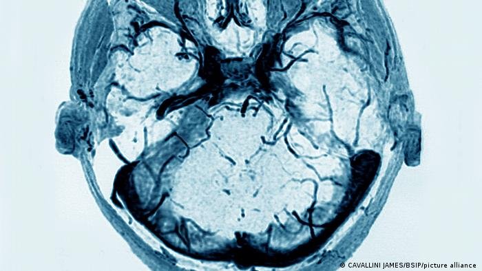brain egefalos