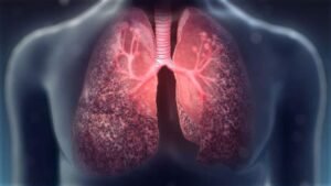 cystic-fibrosis-1024x576-min