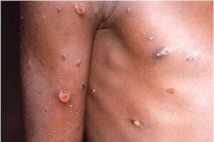 monkeypox evlogia pithikon