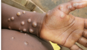 Εντοπισμός κρούσματος της mpox στην Γκάμπια