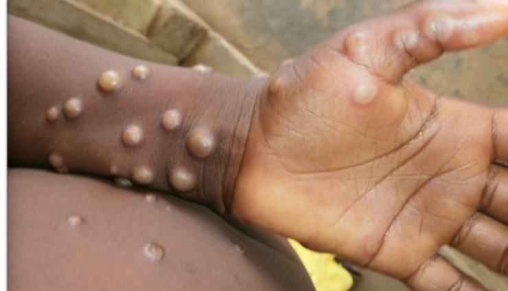 Εντοπισμός κρούσματος της mpox στην Γκάμπια